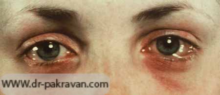 آلرژی در چشم‌ها